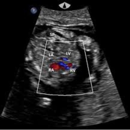 Color Doppler Echocardiogram