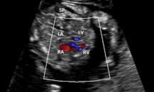 Color Doppler Echocardiogram